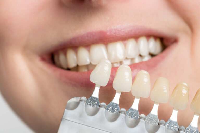 dentist using shade guide at woman's mouth to check veneer of to
