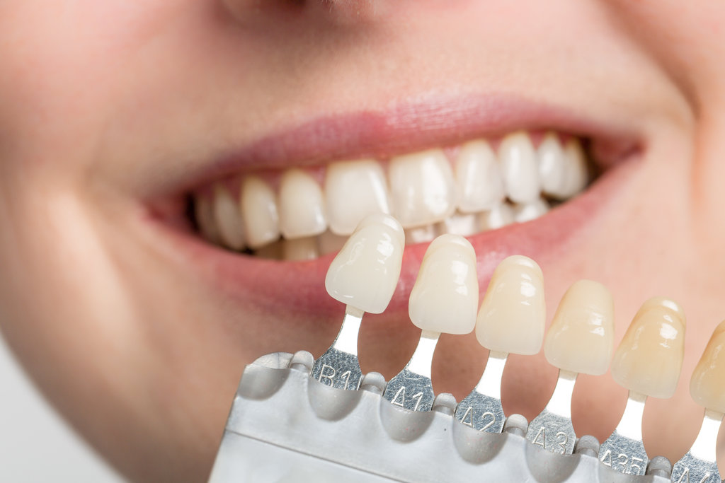 dentist using shade guide at woman's mouth to check veneer of to